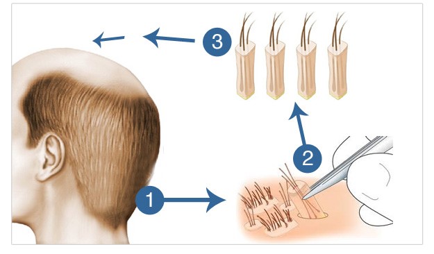 FUE (Follicular Unit Extraction)